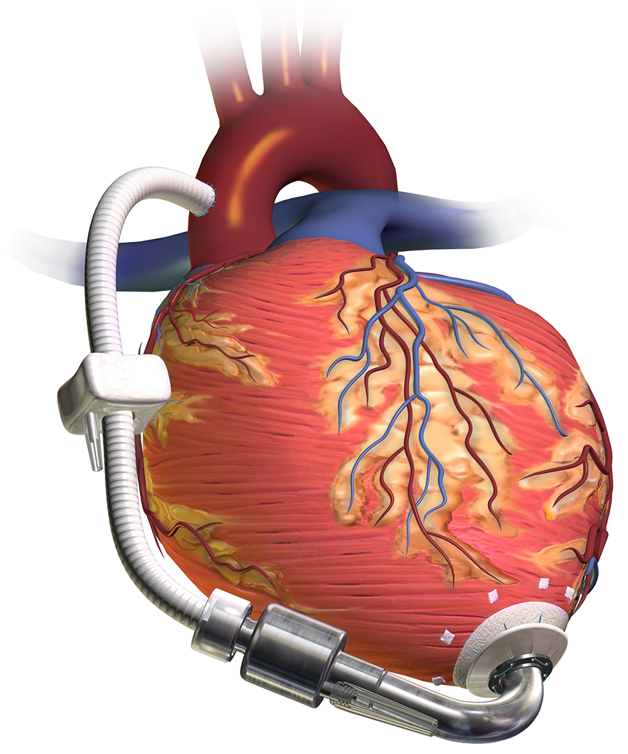 Illustration of a heart pump